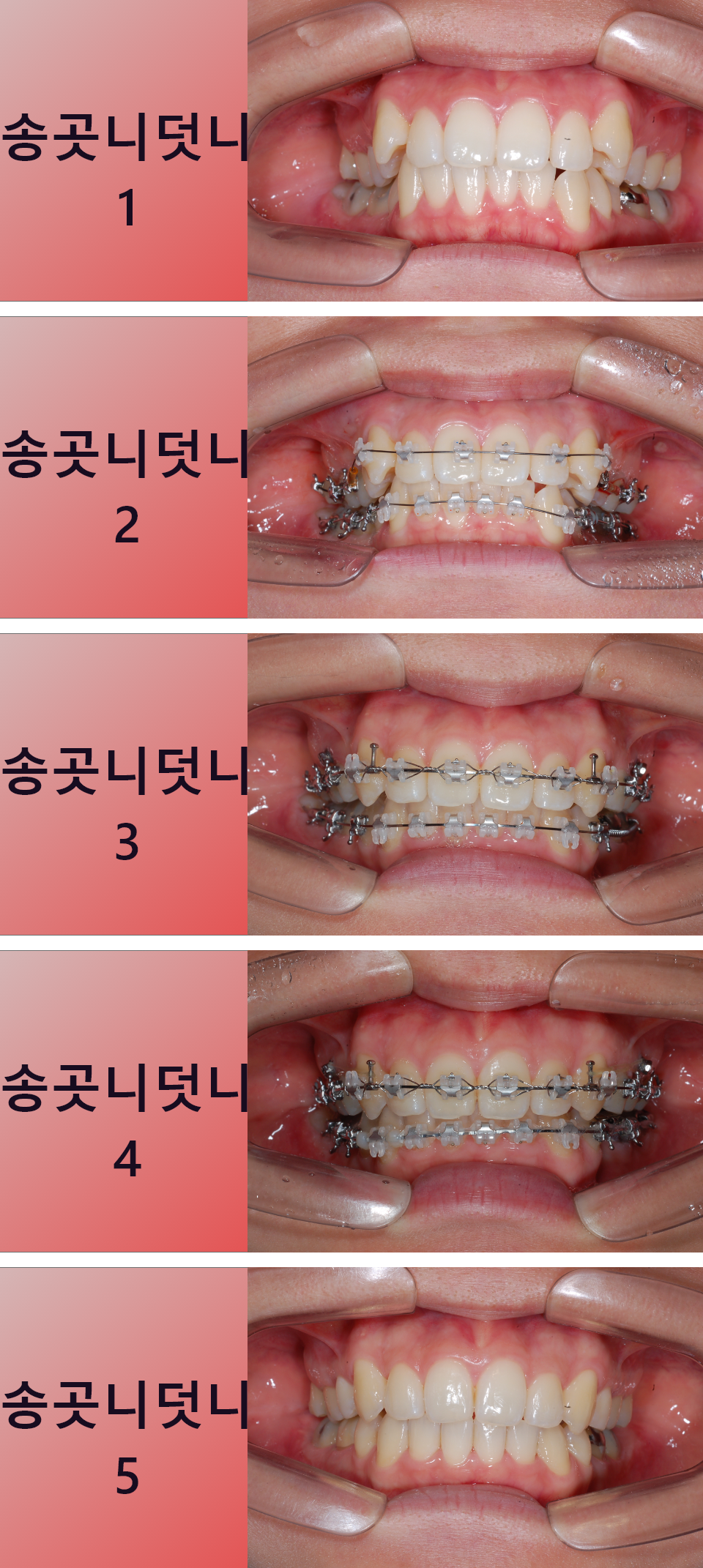 송곳니덧니교정과정(돌출입증상과 함께) 관련 이미지 1
