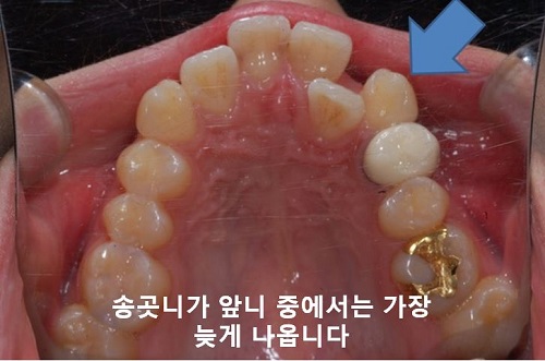 덧니교정과정, 4가지 요점만 알고 시작하세요! 관련 이미지 5