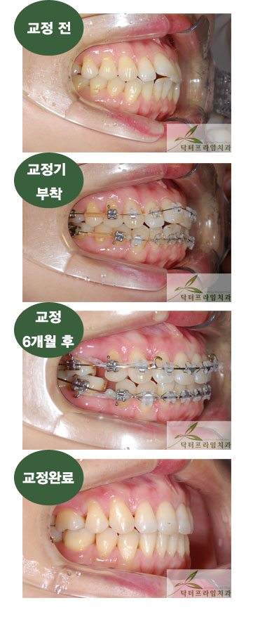 [치아교정후기] 30대후반의 앞니돌출교정전후. 교정기간은 나이에 거의 비례하는 경향이 있어요~~!! 관련 이미지 1