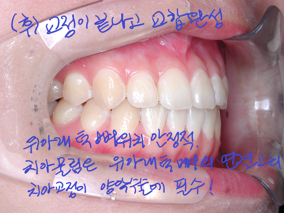 [치아교정] 양악수술방법. 선수술(=후교정)과 선교정(=후수술) 어느것이 더 좋을까? 관련 이미지 8