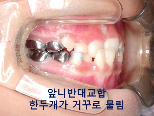 초등학생 앞니반대교합의 교정시기 안놓치는 법! 관련 이미지 6