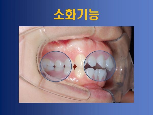 성장기 부정교합 방치했을때의 부작용! 관련 이미지 3