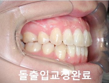돌출입교정에 성공하는 방법 3가지! 관련 이미지 12