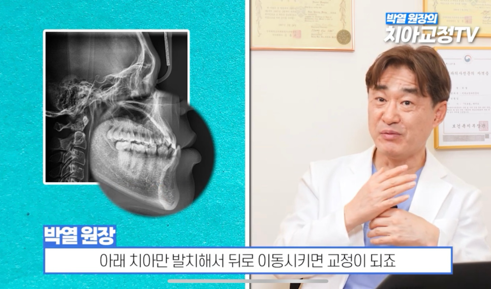 Can Adult Crossbite Be Treated With Orthodontic Dental Care? image 20