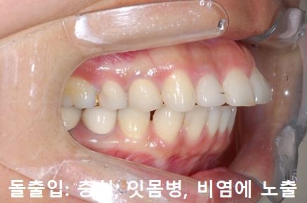 돌출입교정에 성공하는 방법 3가지! 관련 이미지 5