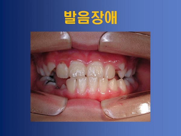 성장기 부정교합 방치했을때의 부작용! 관련 이미지 7
