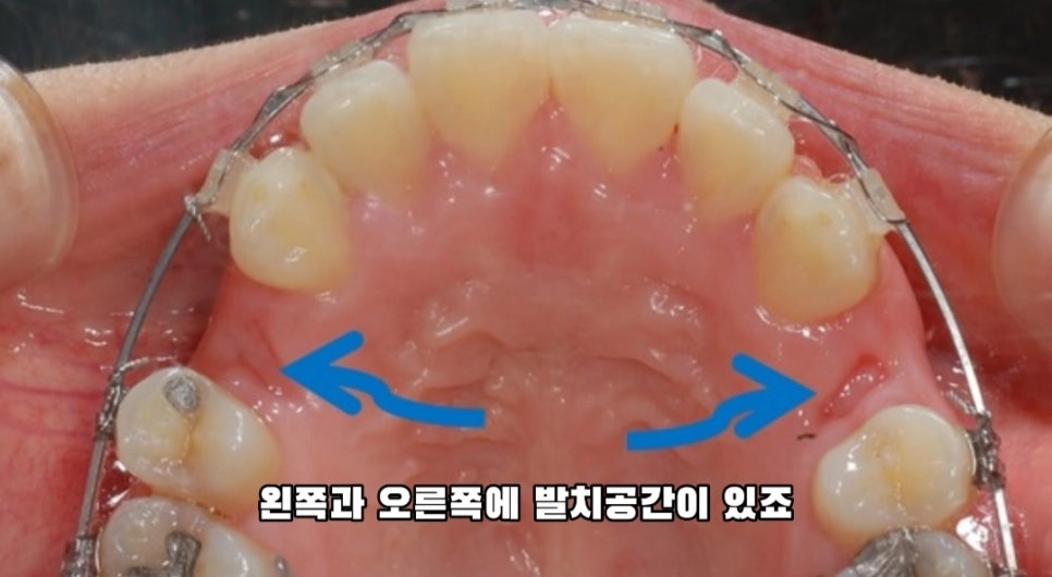 돌출입 교정 하실 분, 이것만은 꼭 알고 시작해야 합니다! 관련 이미지 3
