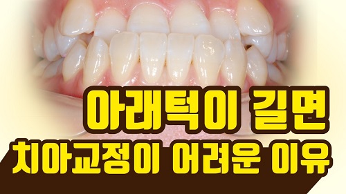 덧니와 주걱턱이 같이 있는 경우에 가장 효과적인 교정방법! 관련 이미지 1
