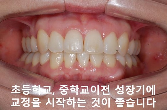 덧니교정이 곧 입매교정! 관련 이미지 12