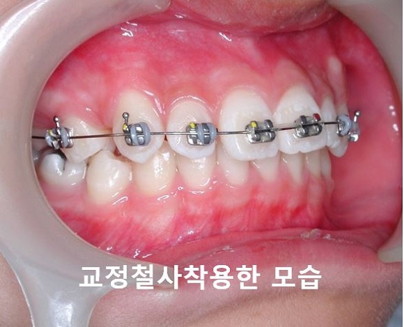 [교정기부착] 돌출입교정할때 교정기부착하는 법! 관련 이미지 10