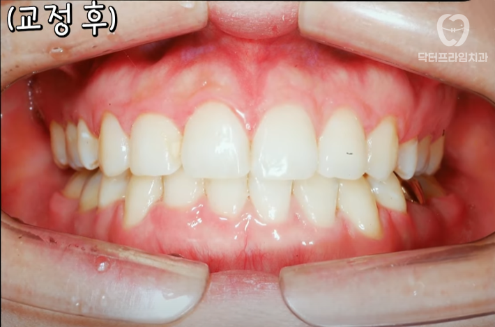 Facial asymmetry turns out to be caused by tooth alignment—can be improved with orthodontics! image 7
