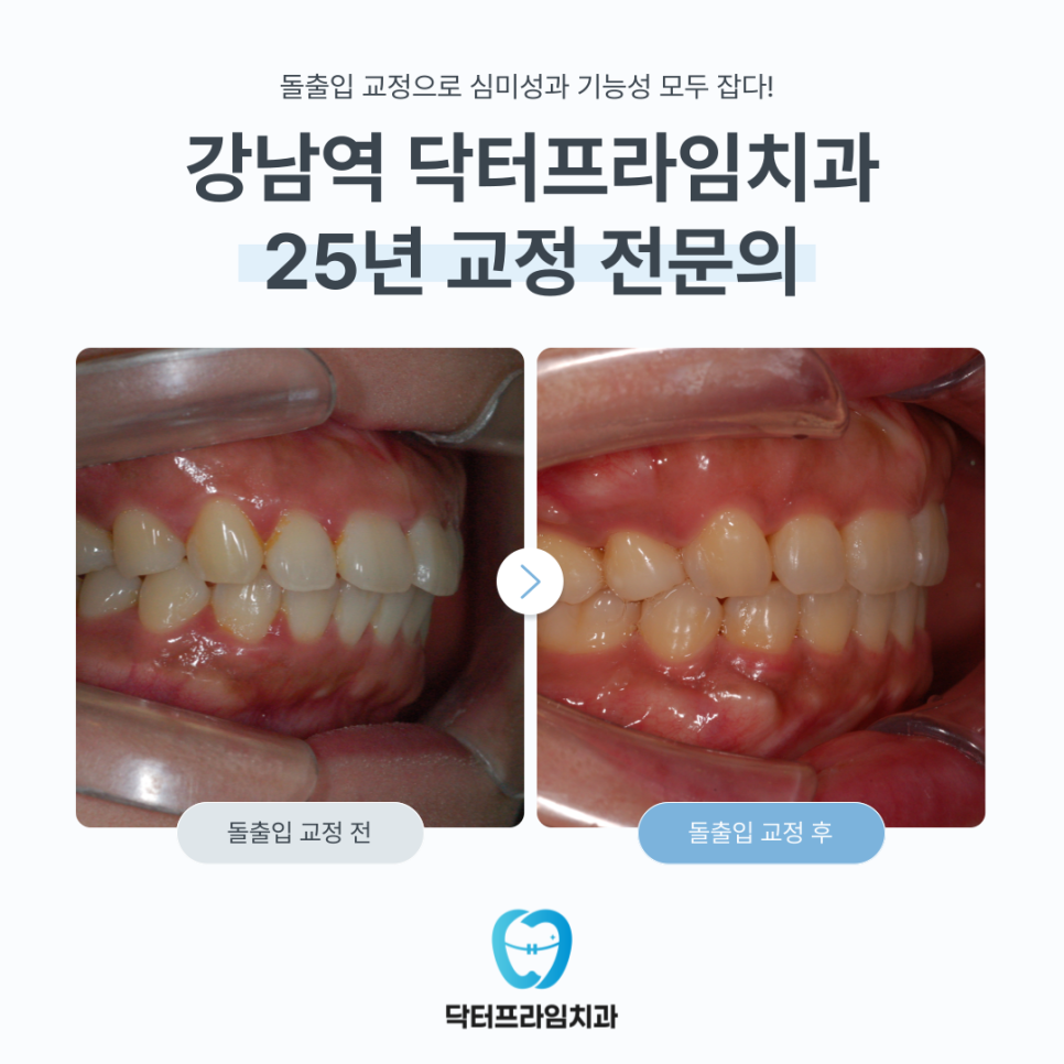 돌출입 교정 심미성과 기능성 모두 잡다! 강남역 닥터프라임치과 25년 교정 전문의 관련 이미지 1