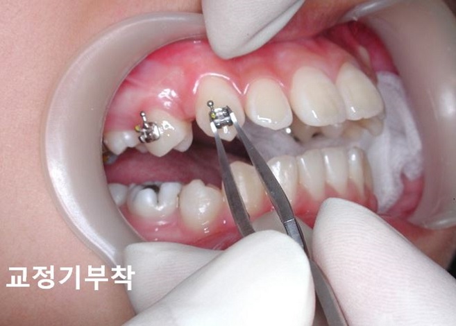 [교정기부착] 돌출입교정할때 교정기부착하는 법! 관련 이미지 6