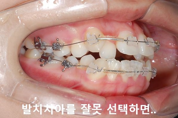 덧니교정 조심할것 3가지 관련 이미지 3