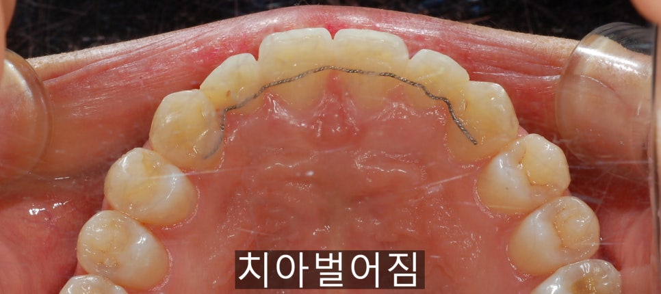 20세이상의 치아벌어짐, 교정 Vs 라미네이트! 관련 이미지 9