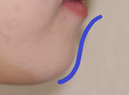 [치아교정] 무턱(돌출입+무턱)인데 아래치아를 발치하면 더 무턱이 되지 않나요?? 관련 이미지 6