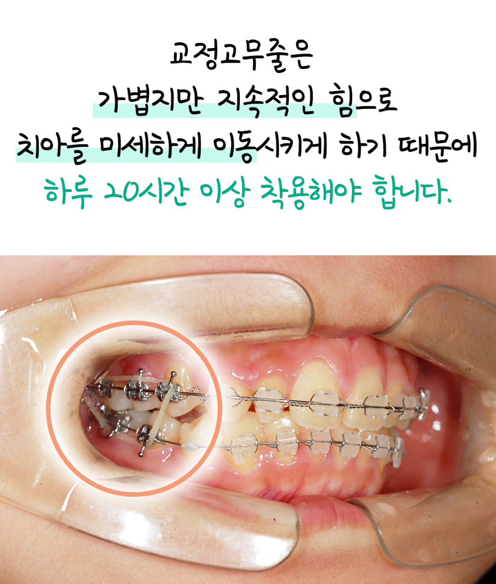 교정 고무줄, 그냥 끼는 게 아닙니다! 위치&middot;시간&middot;지속이 핵심입니다. 관련 이미지 4