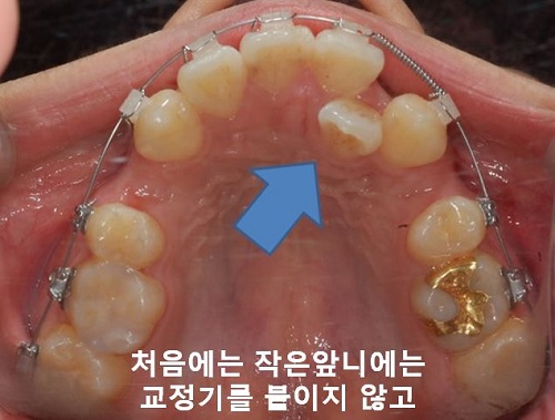 덧니교정과정, 4가지 요점만 알고 시작하세요! 관련 이미지 13