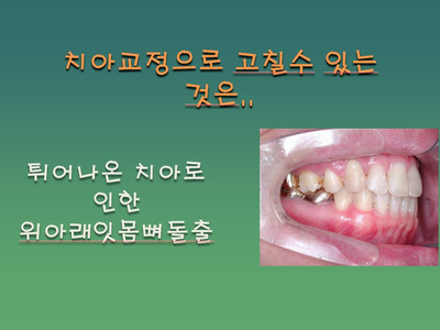 [치아교정] 양악수술과 치아교정(기본개념) 관련 이미지 2