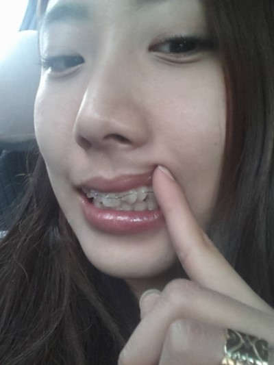 [치아교정후기] 덧니교정후기(1) 관련 이미지 8