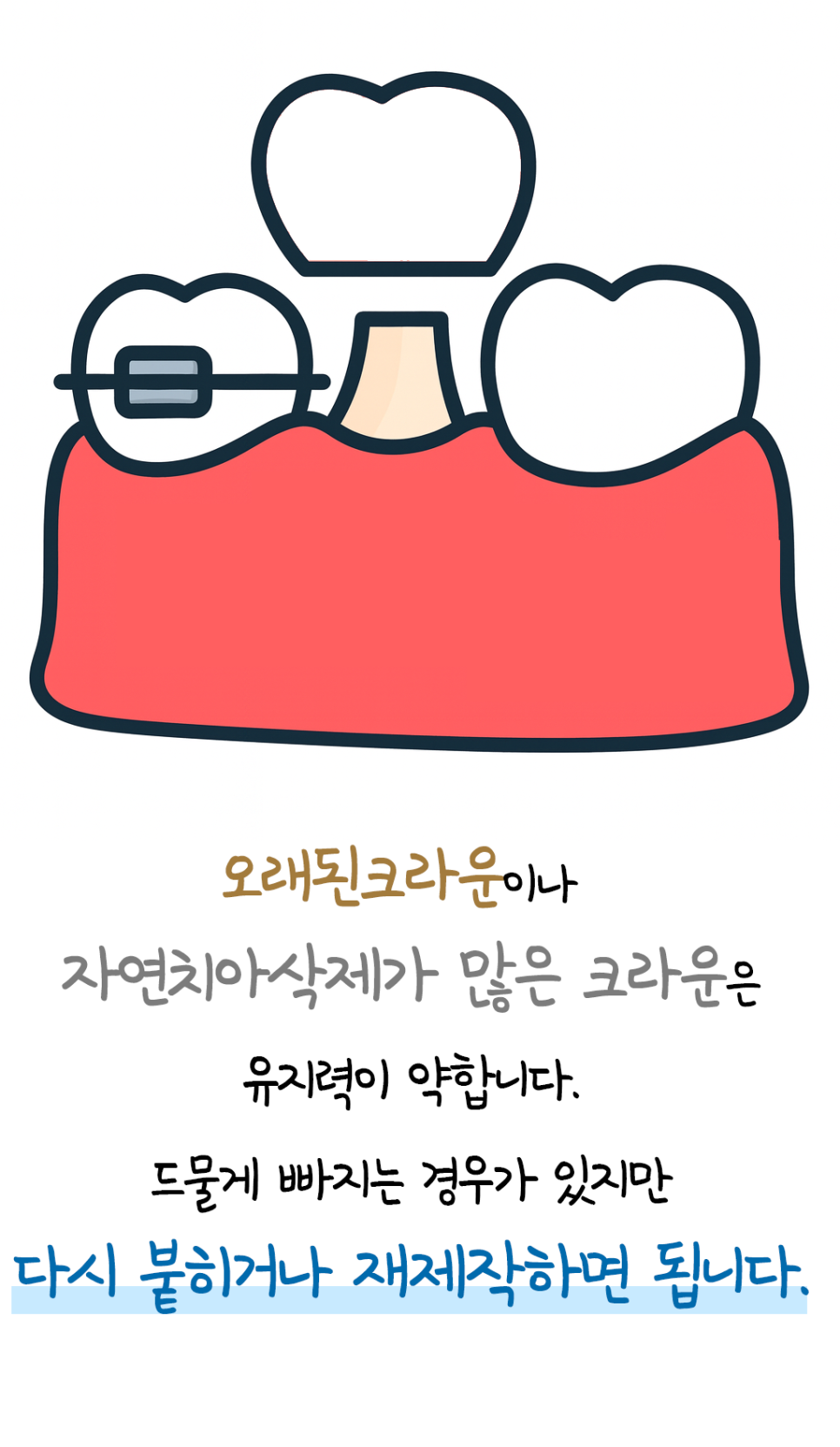 지르코니아, 골드크라운, 브릿지가 있어도 교정 가능한가요? &ndash; 주의할 점과 교정 후 관리까지 관련 이미지 4