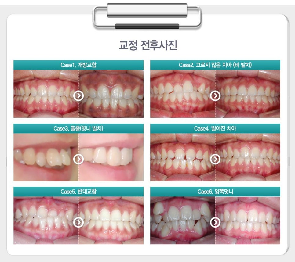 치아교정의 종류 4가지 1) 세라믹교정 2) 클리피시교정 3)설측교정 4) 투명교정 관련 이미지 7