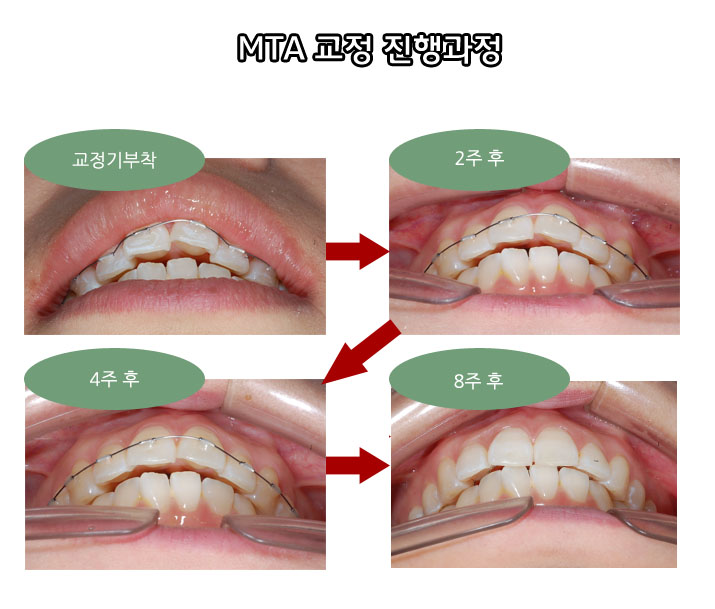[치아교정후기] 앞니부분교정, 단기교정, MTA교정. 부분교정은 잘 선택하면 효율적 결과, 잘못 선택하면 만족도와 안정성에 문제있음!! 관련 이미지 1