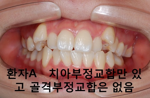 덧니와 주걱턱이 같이 있는 경우에 가장 효과적인 교정방법! 관련 이미지 4