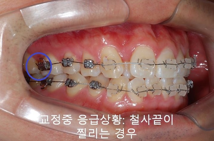 교정치과 잘 고르는 법! 먼 치과, 근처치과!! 관련 이미지 5