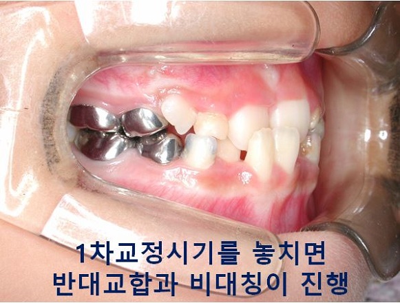 초등학생 앞니반대교합의 교정시기 안놓치는 법! 관련 이미지 8