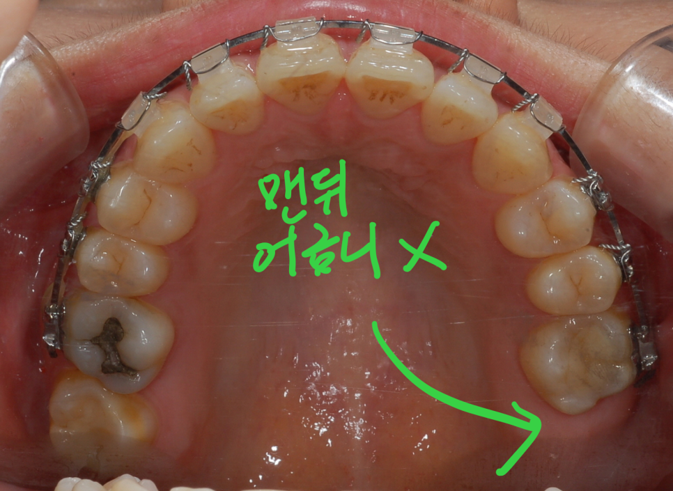 [치아교정] 맨뒤어금니없는 경우의 돌출입교정전후. 교정끝나고 어금니임플란트해야. 차후 교정예정이신 분은 임플란트 먼저하는 것을 신중히 결정할것! 관련 이미지 2