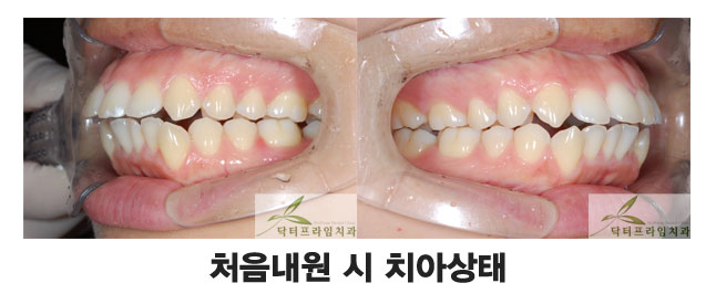 [치아교정후기] 돌출입교정전후. 거미스마일사례 관련 이미지 1
