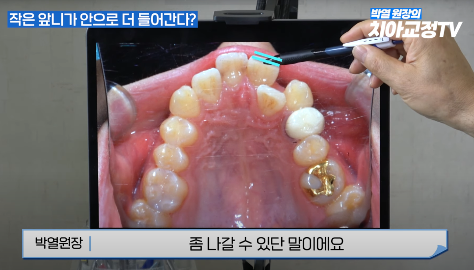 강남역 교정치과 :: 앞니 교정 시작 전에 꼭 알아야 할 한 가지 사실! 관련 이미지 10