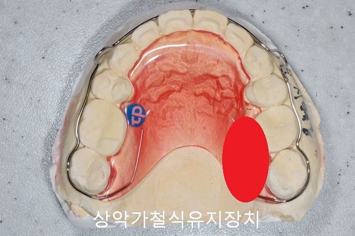 치아교정) 유지장치는 평생 해야 한다? 관련 이미지 6