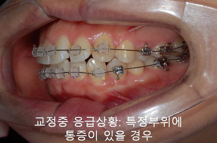 교정치과 잘 고르는 법! 먼 치과, 근처치과!! 관련 이미지 7