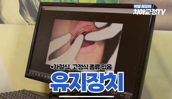 How to Use Retainers After Orthodontic Treatment, Explained by an Orthodontic Specialist with 25 Years of Experience image 2
