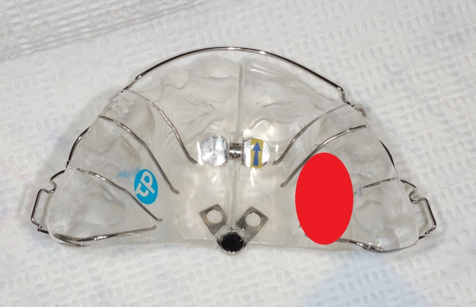 [초등학생치아교정] 초등학생 교정기 제작과 착용시간 관련 이미지 2
