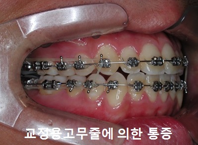 교정시작을 망설이게 하는 치아교정통증(2) 관련 이미지 12