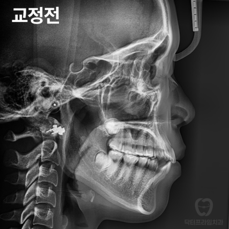 강남역 교정치과, 돌출입 발치교정하면 합죽해진다? 그렇습니다. 사실입니다 관련 이미지 3