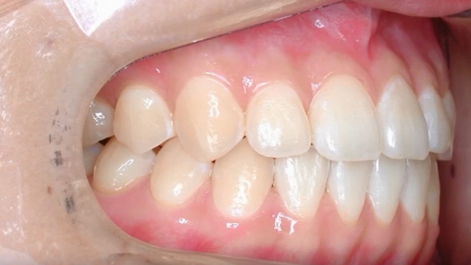 [치아교정] 양악수술에서 치아교정이 필요한 이유 관련 이미지 3