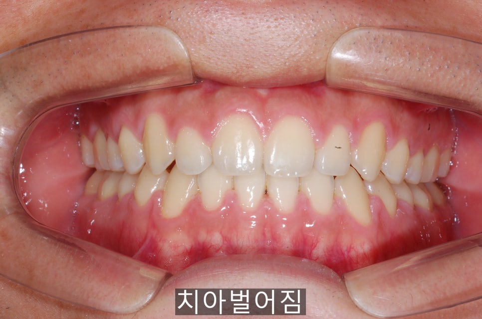 20세이상의 치아벌어짐, 교정 Vs 라미네이트! 관련 이미지 5