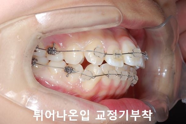 튀어나온입 교정과정 4단계요약 관련 이미지 3