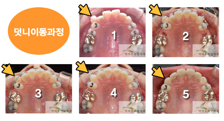 [치아교정후기] 송곳니덧니와 덧니교정전후 관련 이미지 2