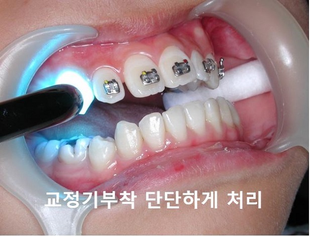 [교정기부착] 돌출입교정할때 교정기부착하는 법! 관련 이미지 7