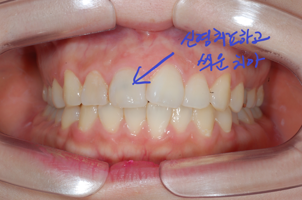 [치아교정] 앞니신경치료했어도 돌출입이나 치아교정 가능한가요? 대부분은 가능합니다. 그러나... 관련 이미지 2