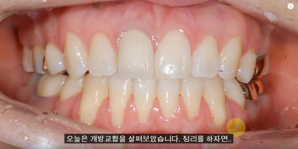 [치아교정] 개방교합의 증상, 원인,교정방법(앞니개방교합) 관련 이미지 4