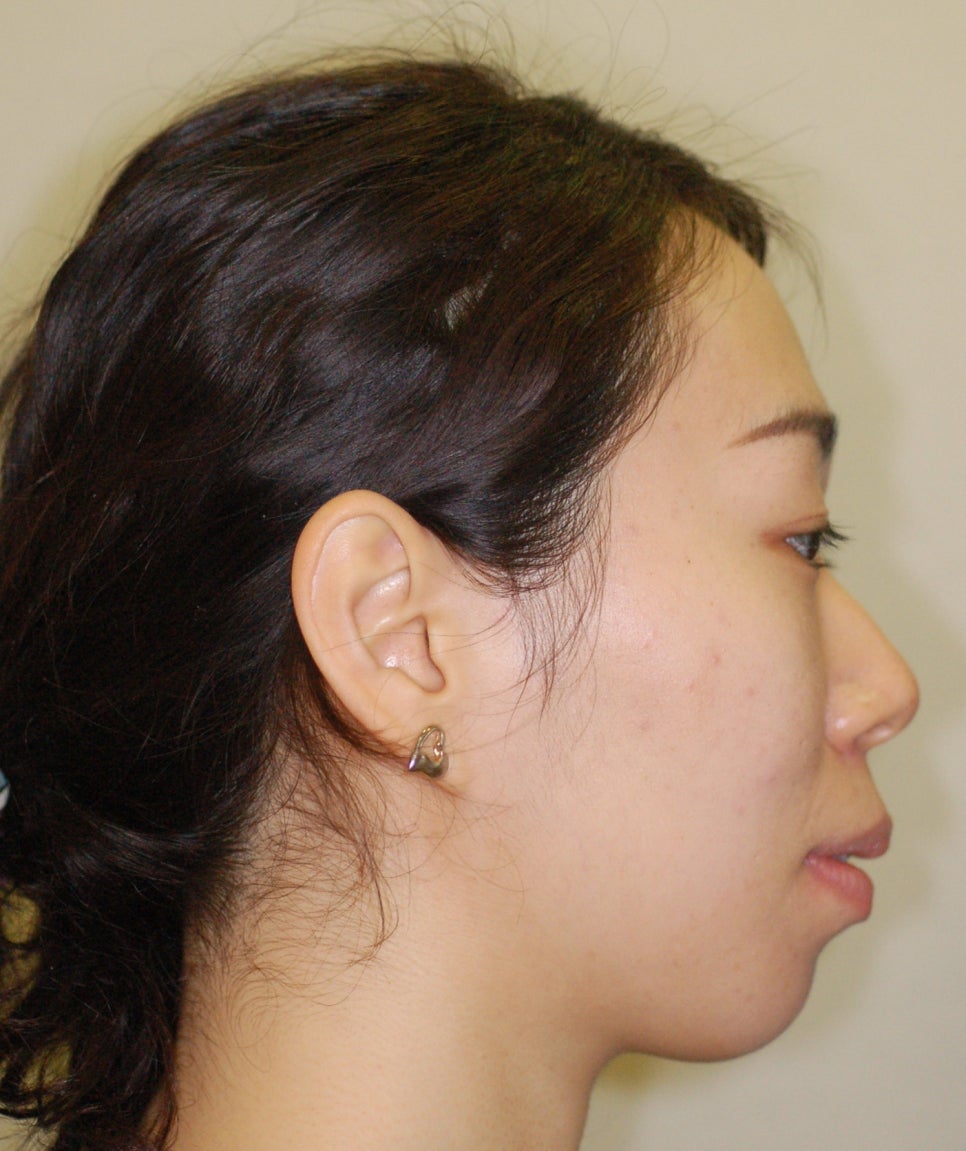 돌출입과 치아교정. 돌출입증상 간단히 보시겠습니다! 관련 이미지 6