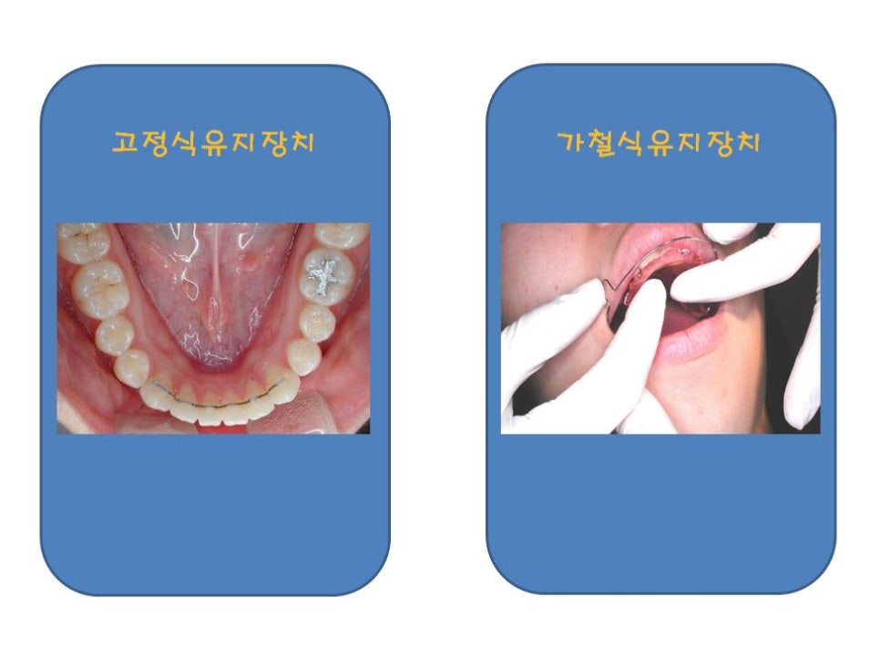 [치아교정] 교정유지장치, 얼마나 중요하지 아시나요?? 관련 이미지 3
