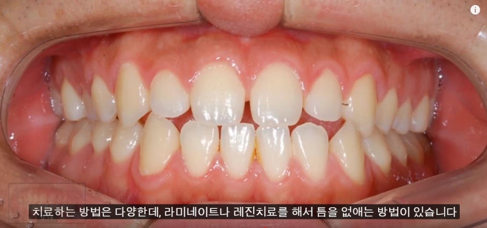 [치아교정] 치아사이에 틈새가 있는 부정교합(레진이나 라미네이트말고 치아교정으로 틈새닫기) 관련 이미지 4