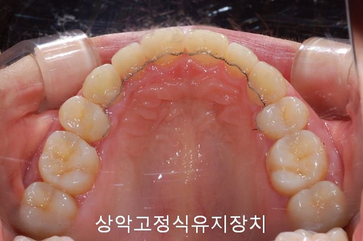 치아교정) 유지장치는 평생 해야 한다? 관련 이미지 7